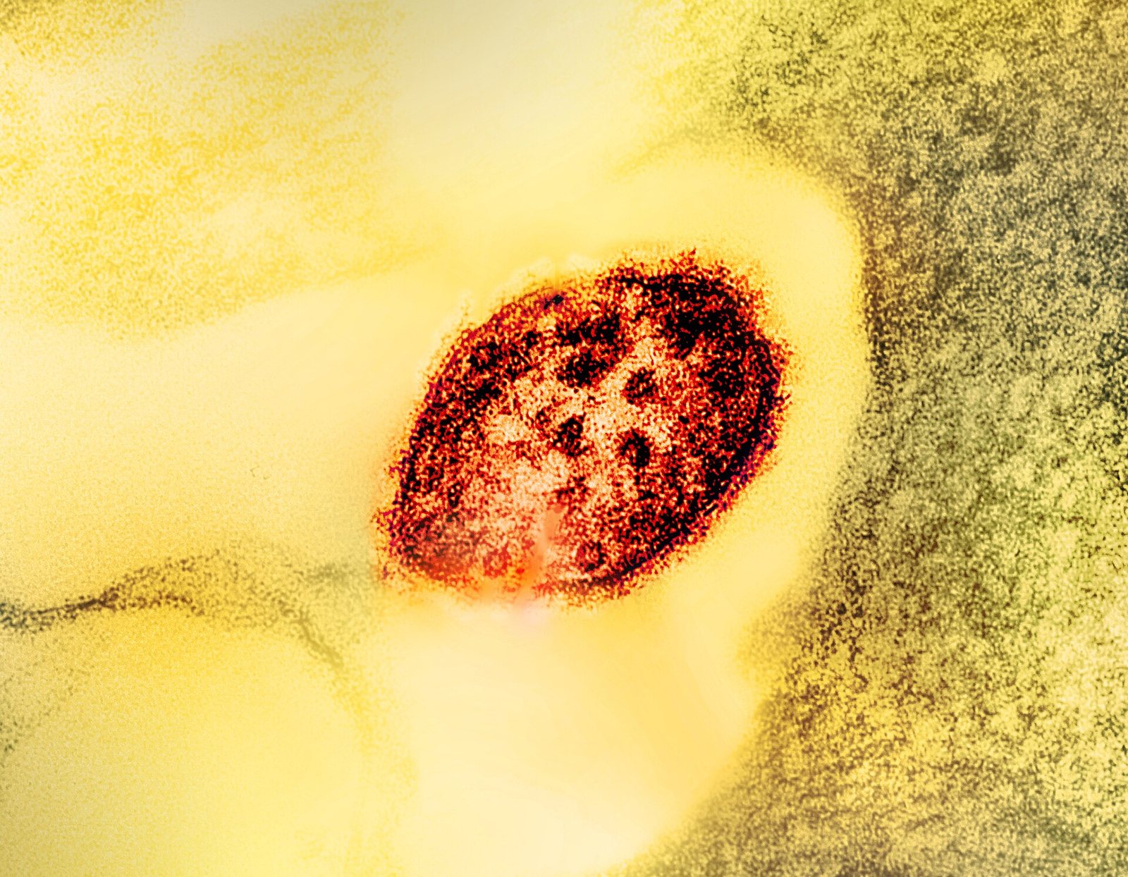 Colorized electron micrograph of a measles virus particle — illustrative